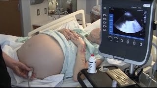 Ultrasound for Paracentesis  BAVLS [upl. by Ahseinod]