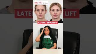 Eye Brow Lift  Dr Ekta Mishra Gautam  GBL Hospitsl IndoreGBL [upl. by Kauffmann]