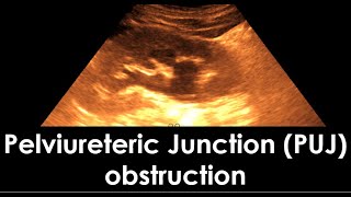 Pelviureteric Junction PUJ obstruction  dilatation of the pelvicaliceal system  Hydronephrosis [upl. by Eustashe139]