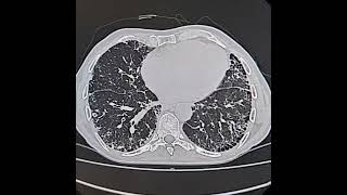 Usual interstitial pneumoniaIdiopathic pulmonary fibrosis [upl. by Ok102]