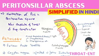 Peritonsillar Abscess  Quinsy  Hindi  ENT [upl. by Lonnie53]