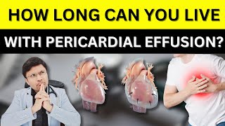 Pericardial Effusion Causes Symptoms Diagnosis amp Treatment PERICARDIALEFFUSION [upl. by Alad]