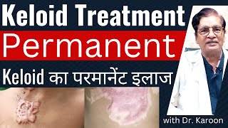 Keloid Removal Treatment  Keloid का इलाज  Dr Karoon Agrawal [upl. by Lowney353]