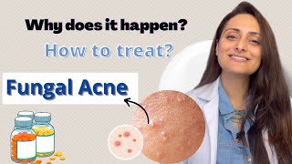 Fungal Acne  Why does it happen  How to treat  Dermatologist  Dr Aanchal Panth [upl. by Ravel113]