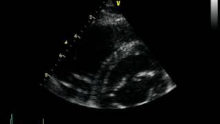 ARVC ARRHYTHMOGENIC RIGHT VENTRICULAR CARDIOMYOPATHY DAVD [upl. by Akla]