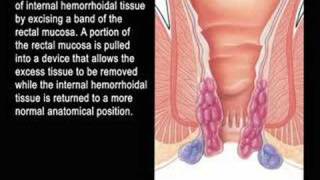 procedure for prolapsing hemorrhoids [upl. by Etnoj]