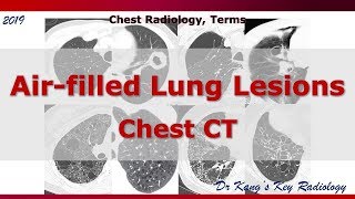 Air filled lung lesions CT Terms [upl. by Brent]