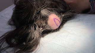 HUGE CYST ON THE SCALP [upl. by Osnofledi]