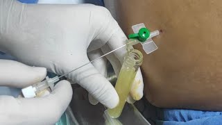 Remove abdominal fluid ascites  Paracentesis  Ascitic fluid aspiration [upl. by Fellner]