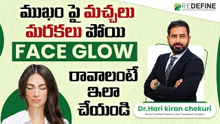 How to Get Glowing Skin on Face  Best Way to Remove Acne Scars and Dark Spots  ReDefine Channel [upl. by Feldman]