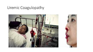 Uremic Coagulopathy [upl. by Mylor]