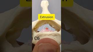 Cervical Disc Herniation Takes Time anatomy [upl. by Noland]