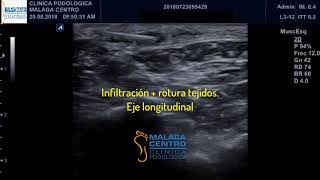 Enfermedad de Ledderhose o Fibromatosis plantar Tratamiento mediante ecografía [upl. by Rochemont577]