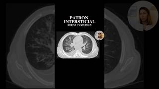 Edema pulmonar 💦🫁 con patrón reticular en tomografia ✅ radiologia torax medicina [upl. by Brote]