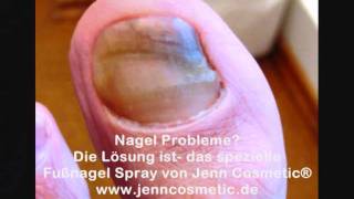 Nagel Problem Fußnägel brüchig Fußnägel Querrillen [upl. by Amity194]