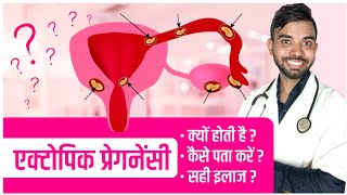 ectopic pregnancy in hindi  ectopic pregnancy signs amp symptoms  एक्टोपिक प्रेगनेंसी के लक्षण [upl. by Notnad]