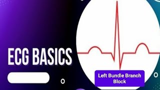 ECG Basics  Left Bundle Branch Block LBBB  Causes of LBBB [upl. by Morrell]