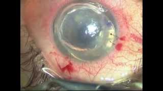 DSAEK IN FAILED PENETRATING KERATOPLASTY PK [upl. by Adamina69]