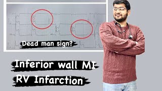 Mastering ECGLesson7 IWMI  RV infarct ECG discussion [upl. by Noella851]