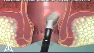 Infrared Coagulation Therapy for Hemorrhoids  3D Medical Animation [upl. by Ramel]