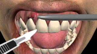 How to treat a tooth abscess [upl. by Ainegue]