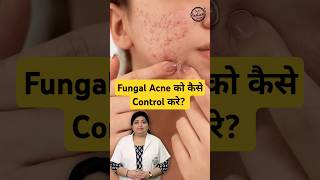 How to treat Fungal Acne on face  Fungal Acne Treatment fungalacne acne skincare shorts [upl. by Suckow]