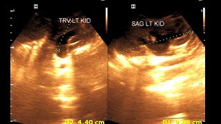 Bilateral hydro nephrosis  Bilateral dilated ureter  Renal Ultrasonography [upl. by Giffie]