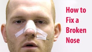 How to Fix a Broken Nose without Sedation Closed Nasal Reduction [upl. by Aihcila729]