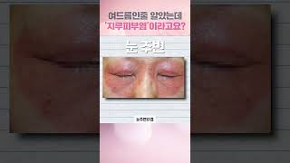 여드름과 비슷해 보이는 지루피부염 증상 얼굴 두피 간지러움 각질 버짐 지성 건성 홍조 화농 염증 피지 흉터 [upl. by Meijer640]