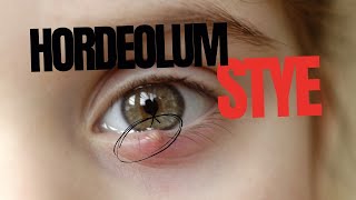 Stye Hordeolum [upl. by Jeramie]