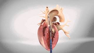 TAVI transapical  Transcatheter Aortic Heart Valve [upl. by Ameehsat402]