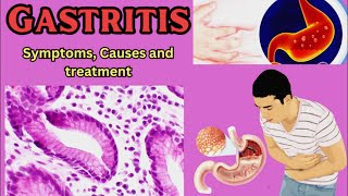 Gastritis Symptoms Causes and Treatment [upl. by Nnaeirual881]