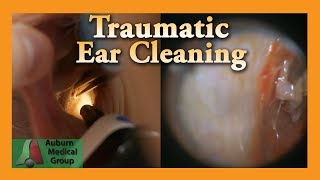 Earwax Removal Abrasion  Auburn Medical Group [upl. by Nosrak41]