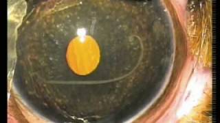 Angiostrongylus nematode worm in eye of puppy  surgical removal [upl. by Woodall508]