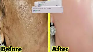 Lacsoft Cream  Remove Pigmentation  Dark spot  Acne amp Acne scars  Brijwasi Girl [upl. by Nnaeinahpets]