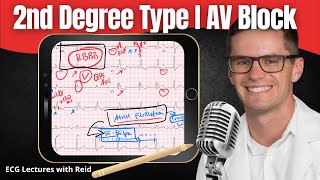 Second Degree Type I AV Block EKG  ECG Lecture [upl. by Netsrejk]