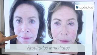 Hilos tensores para el tratamiento facial [upl. by Etti]