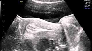 Ultrasound guided Embryo transfer [upl. by Aiekal540]