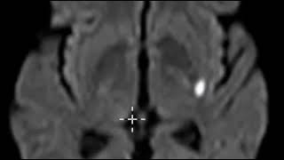 Acute lacunar infarction basal ganglia [upl. by Marquis]