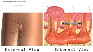 Natural Cure for Pilonidal Sinus Without Surgery  Ayurvedic [upl. by Leandra]