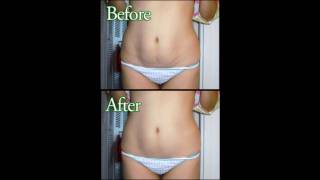 Whats the best stretch marks treatment [upl. by Leno]