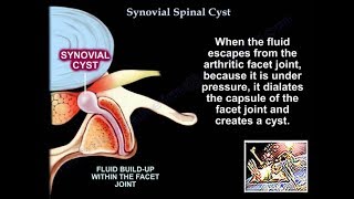 Synovial Cyst Of The Spine  Everything You Need To Know  Dr Nabil Ebraheim [upl. by Eiclud106]