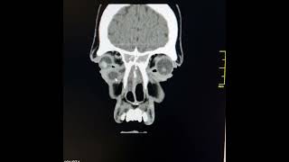 Sinonasal polyposisRight dacryocystitisRight infra orbital abscess [upl. by Moina]