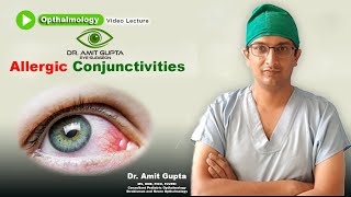 Allergic conjunctivitis  Ophthalmology  Signs and Symptoms  Diagnosis and Treatment [upl. by Ivetts13]