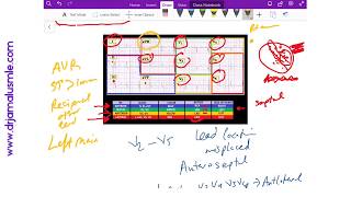 STEMI location on ECG  Dr Jamal USMLE  Cardiology ECG lecture [upl. by Benson]