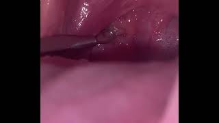 Tonsil stones 24 [upl. by Fanestil]