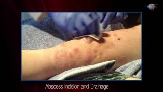 WCW Abscess Incision and Drainage [upl. by Tavish333]