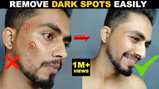 DARK SPOT कैसे हटाये  How To Remove DARK SPOTS amp SCARS NATURALLY ACNE SCARS ACNE MARK  2021 [upl. by Stephens]