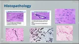 Omneya Wahba Odontogenic Tumors 4 [upl. by Refinne]