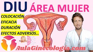 DISPOSITIVO INTRAUTERINO O DIU DE COBRE POR GINECOLOGA DIANA ALVAREZ [upl. by Hanala]